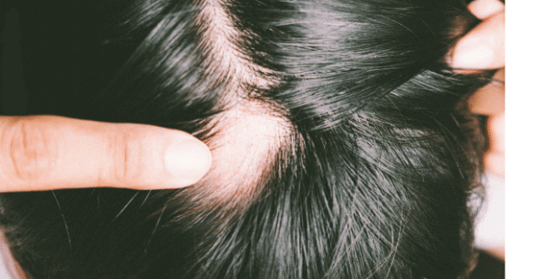hair-loss-problem
