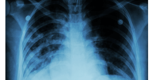 Tuberculosis-diagnosis