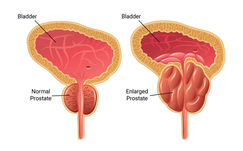 Urinary retention enlarged prostrate